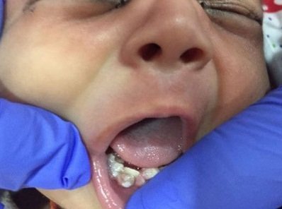 印度新生兒長7顆牙醫生 手術全拔除
