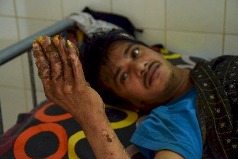 24次手術以為痊癒 孟加拉樹人再度復發