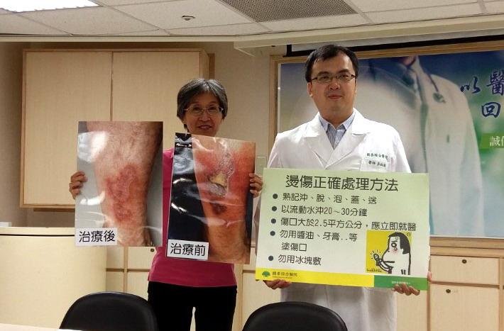 燒艾草解痠痛燙傷 反釀成蜂窩性組織炎