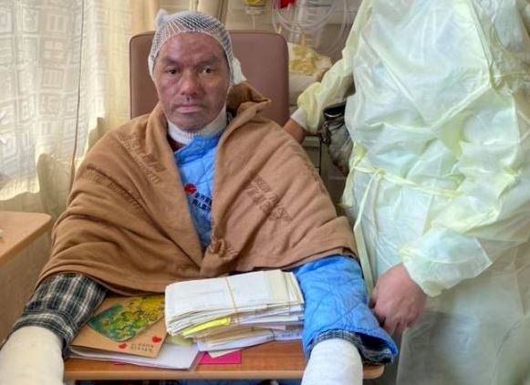 反送中縱火燒人事件 傷者病情已好轉
