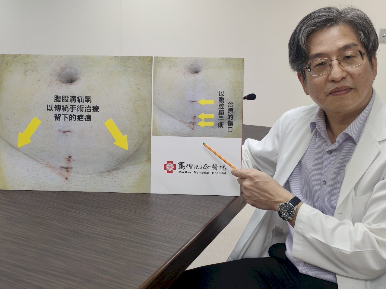 男女老幼都可能疝氣 慢性咳嗽、便祕是危險因子