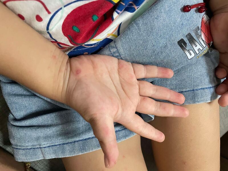 腸病毒疫情創5年新高 醫：腸病毒71型大流行危機尚未解除